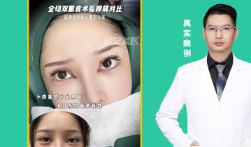 全切双眼皮术后即可对比