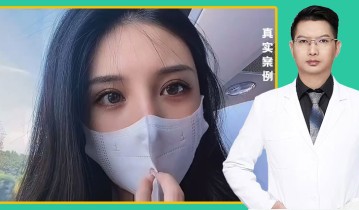 罗飞彪医生-黄金媚眼重睑术效果