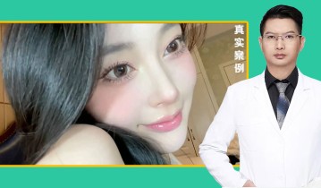 黄金媚眼重睑术效果【2】