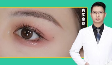 罗飞彪医生-眼综合双眼皮效果